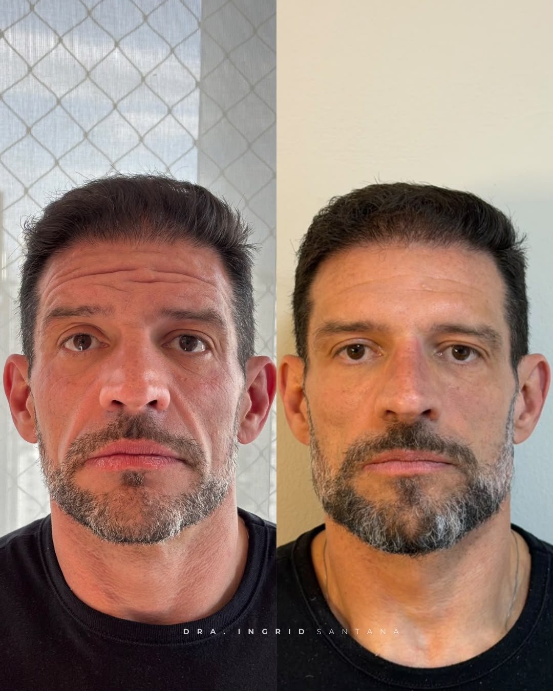 Antes e depois de harmonização full face e toxina botulínica