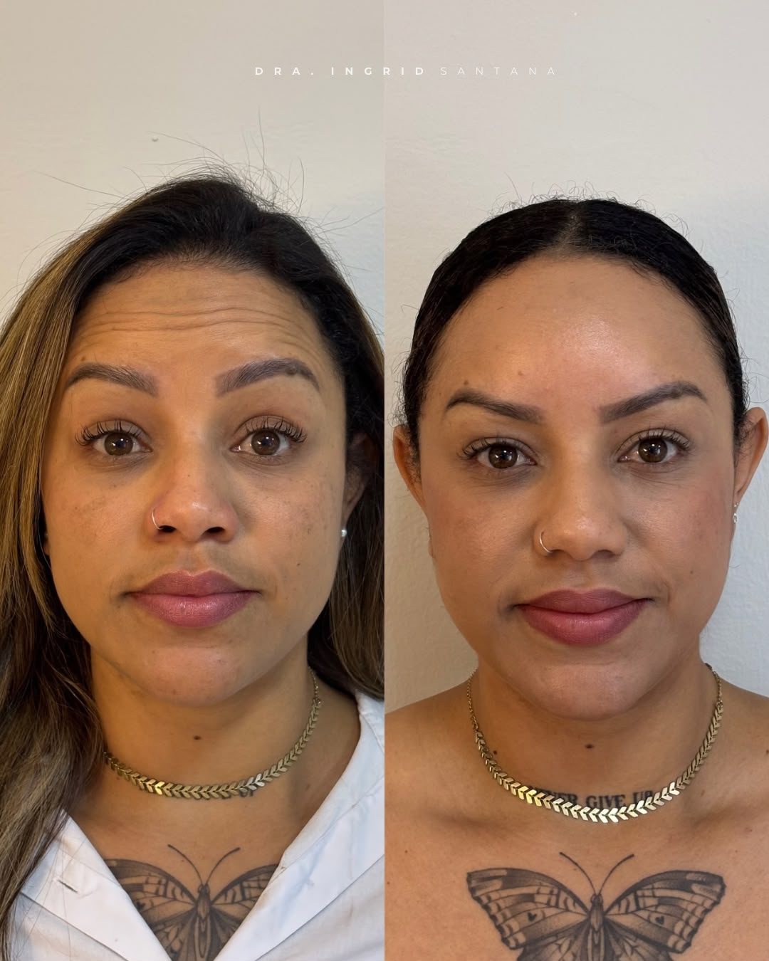 Antes e depois de paciente, resultado 7