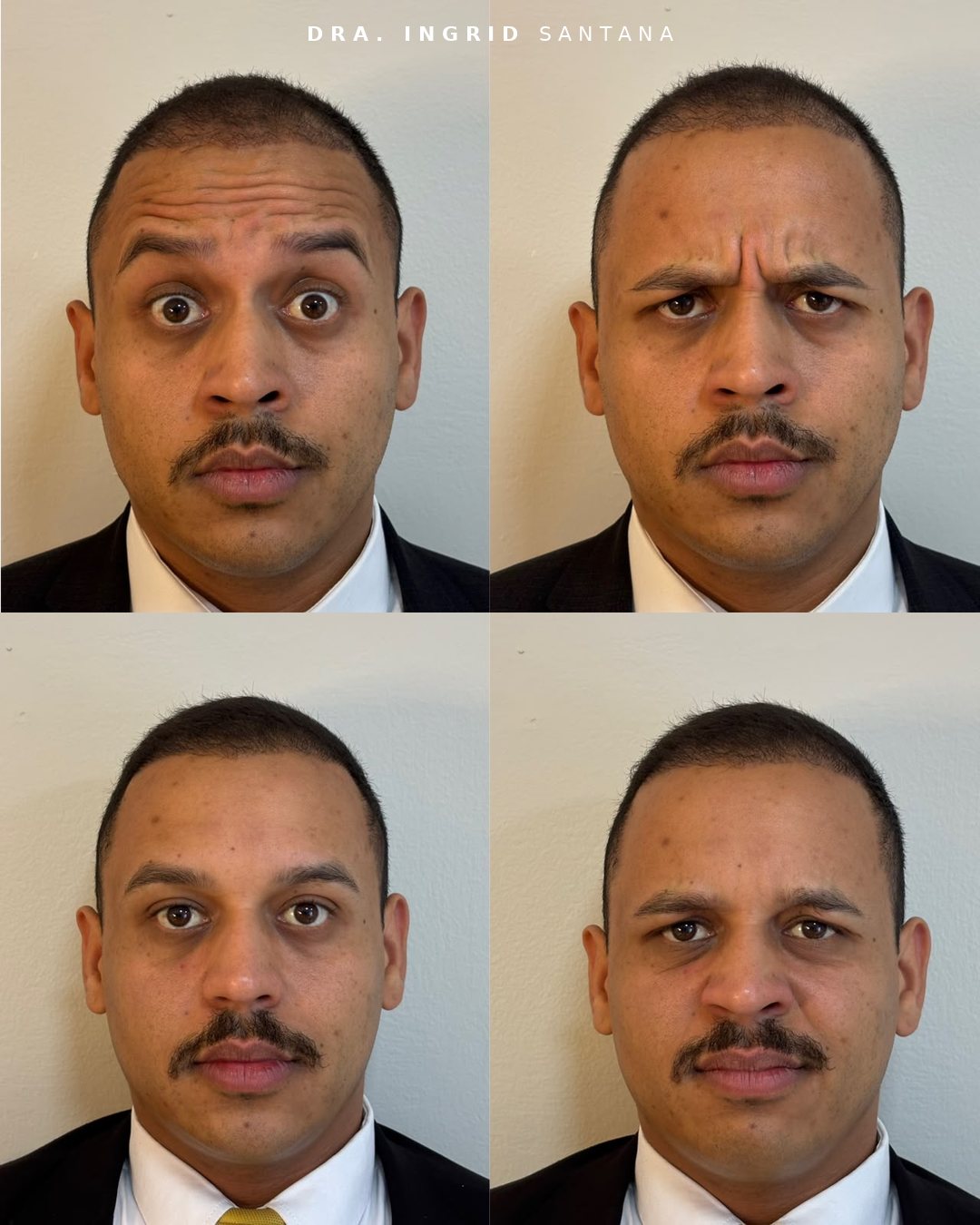 Antes e depois de toxina botulínica: em cima antes, embaixo depois